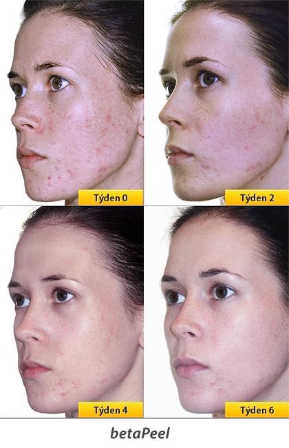 chemicky-peeling